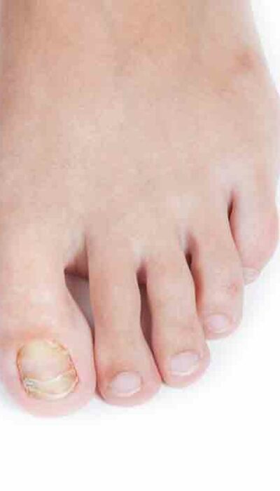 How to Treat Fungal Infections in the Toenails