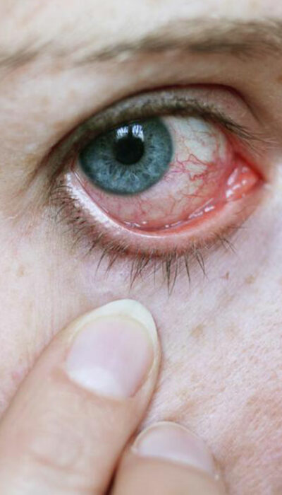 How to Treat Pink Eye with Eye Drops