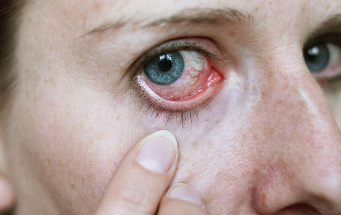 How to Treat Pink Eye with Eye Drops