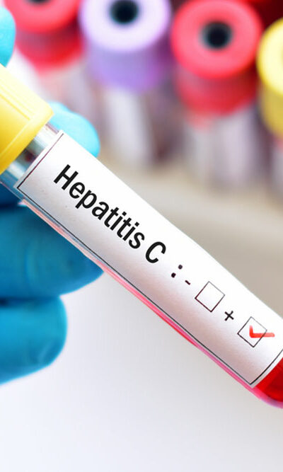 Hepatitis &#8211; types and contributing factors