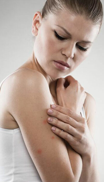 Here Are a Few Things to Know about Eczema Treatments