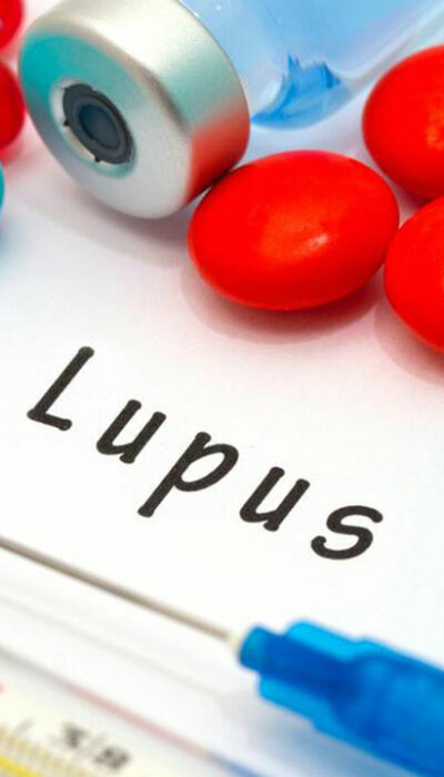 Here Are the 8 Early Signs of Lupus