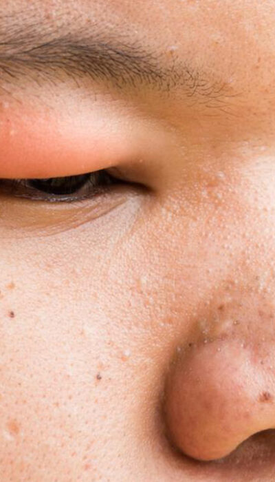 Here&#8217;s How to Get Rid of a Stye With These Simple Steps