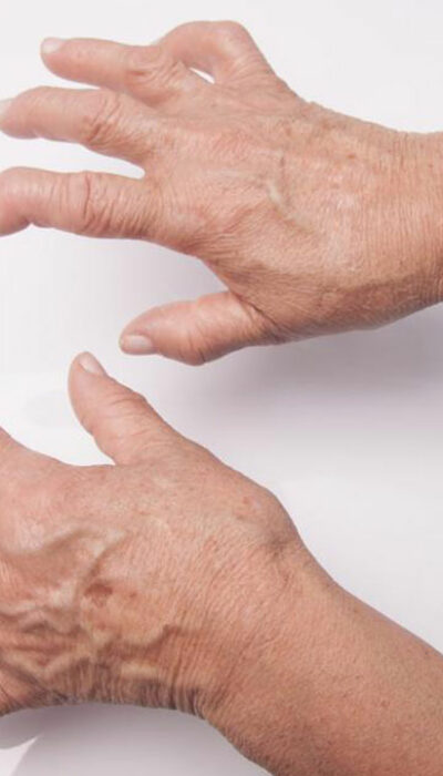 Here&#8217;s What You Need to Know About Rheumatoid Arthritis Symptoms