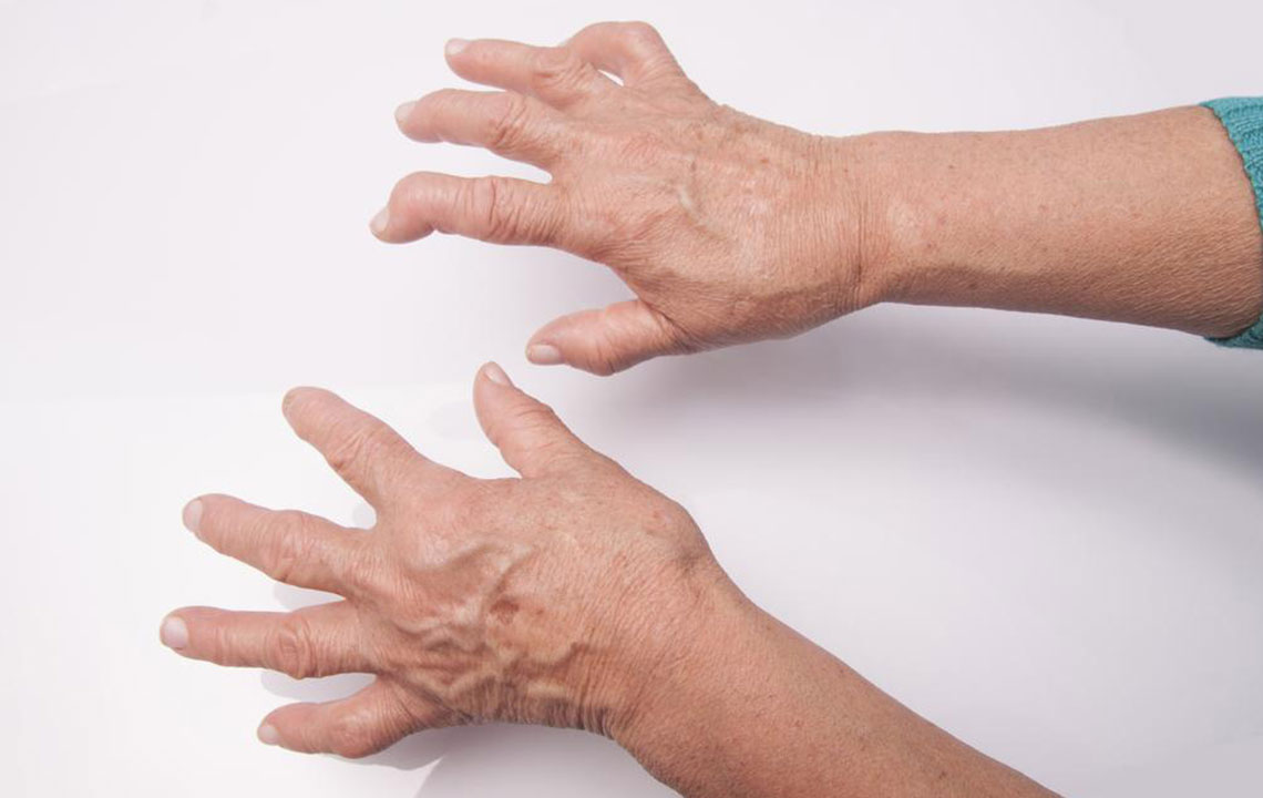 Here&#8217;s What You Need to Know About Rheumatoid Arthritis Symptoms