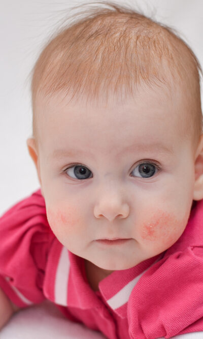 Important Things You Need to Know about Eczema