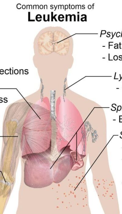 Is your Body Telling You About these Leukaemia Symptoms?