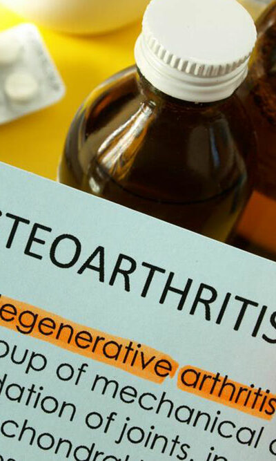 Osteoarthritis &#8211; How to Treat it