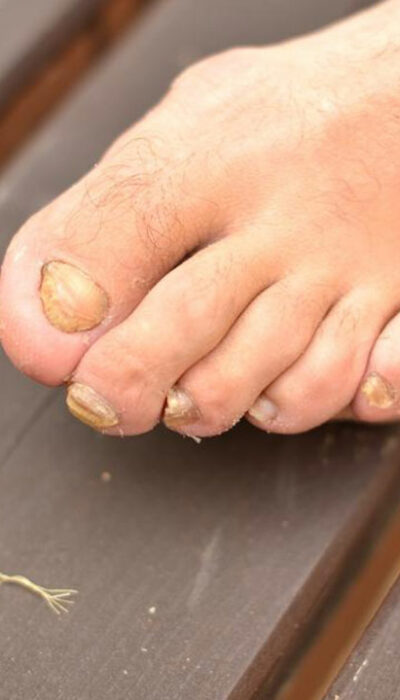 Most Beneficial Home Remedies for Toenail Fungus