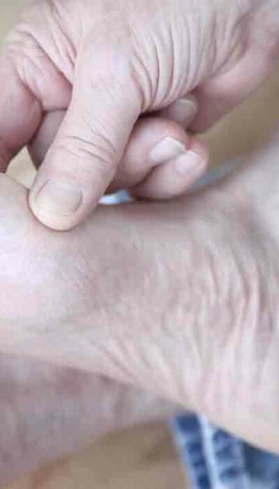 Managing Gout Foot Pain Effectively