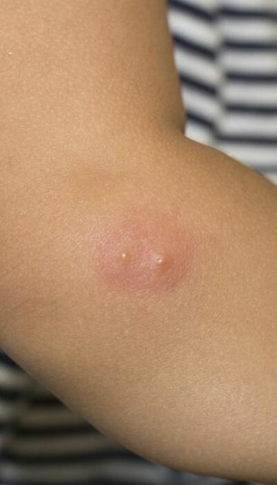 Medical Treatment Options for Shingles