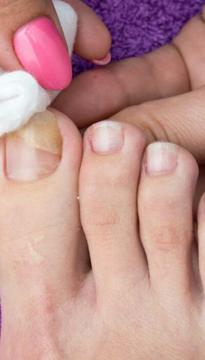 Nail Fungus &#8211; Causes, Symptoms, and Cure