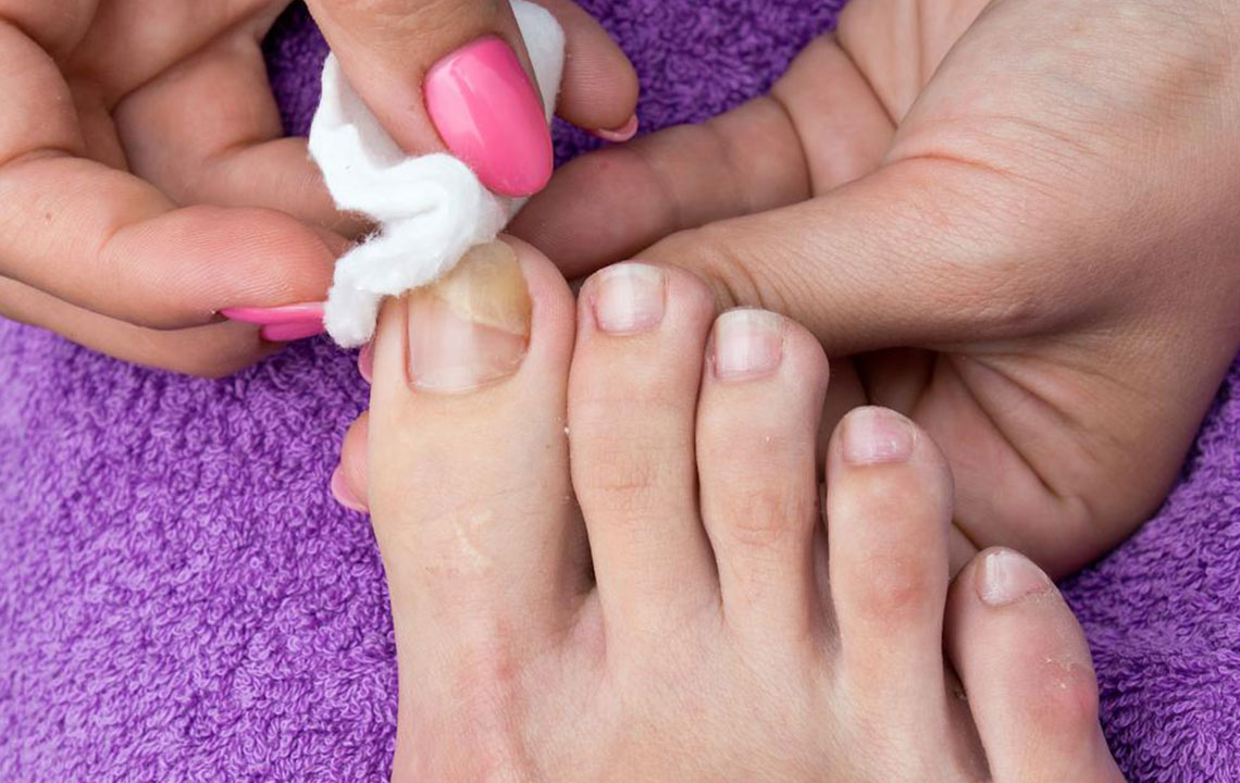 Nail Fungus &#8211; Causes, Symptoms, and Cure