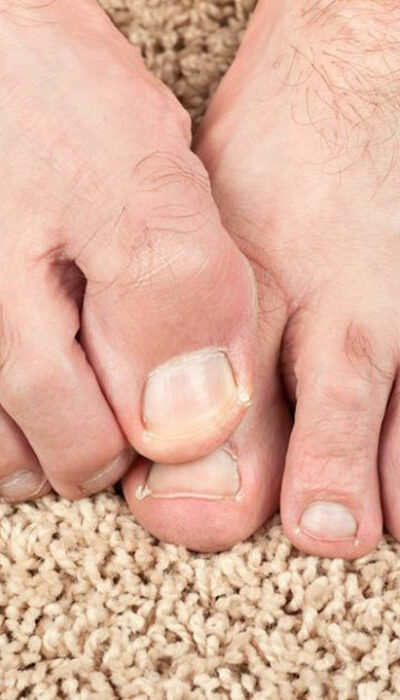 Some Effective Home Remedies for Toenail Fungus