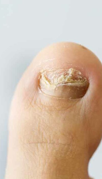 Some tips on how to cure nail fungus