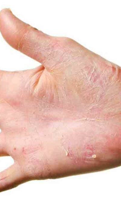 Six creams that can cure eczema