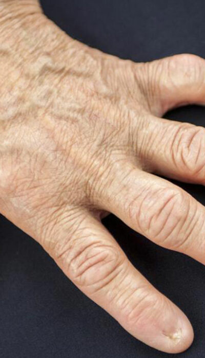 Signs of Rheumatoid Arthritis You Should Look out For