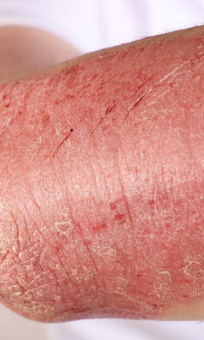 Symptoms, Causes, Types And Treament Of Eczema