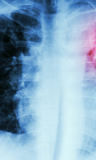 Symptoms and Diagnosis of a Pulmonary Embolism