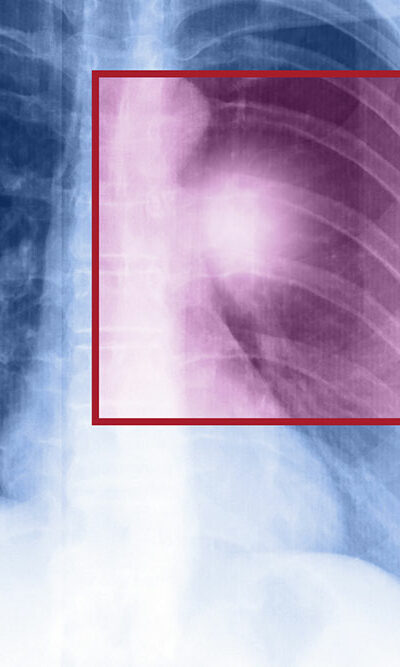 Symptoms and Treatment of Metastatic Lung Cancer