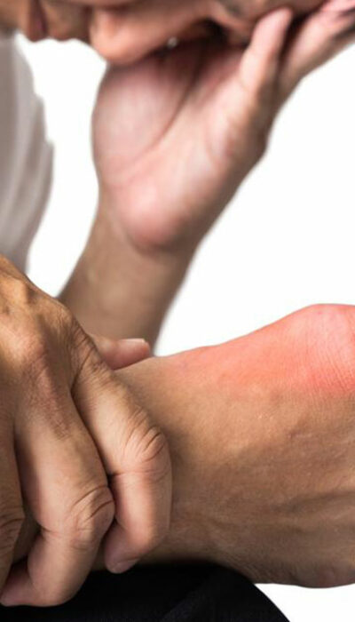 Symptoms and Treatments for Gout