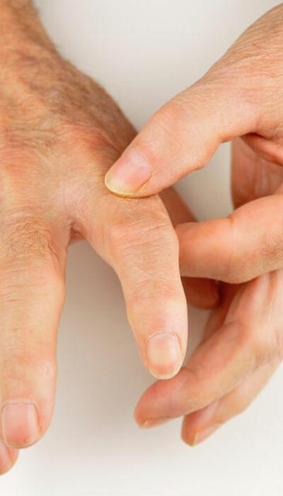 Popular Treatment Options for Rheumatoid Arthritis and Gout