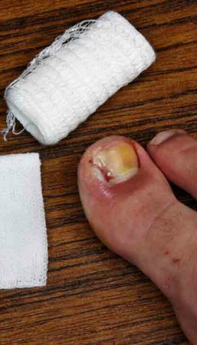 Popular Ways to Treat Toenail Fungus