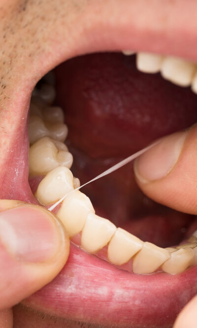 Removing Dental Plaque At Home