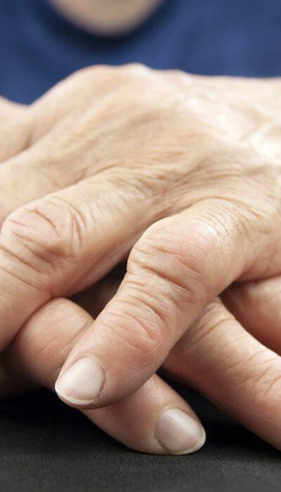 Rheumatoid Arthritis &#8211; Symptoms, Causes, and Remedies