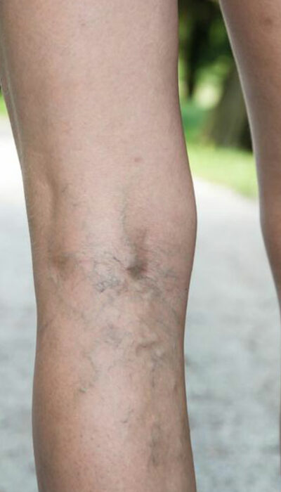 What You Need to Know about Deep Vein Thrombosis