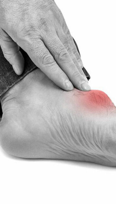 What You Need to Know about Gout