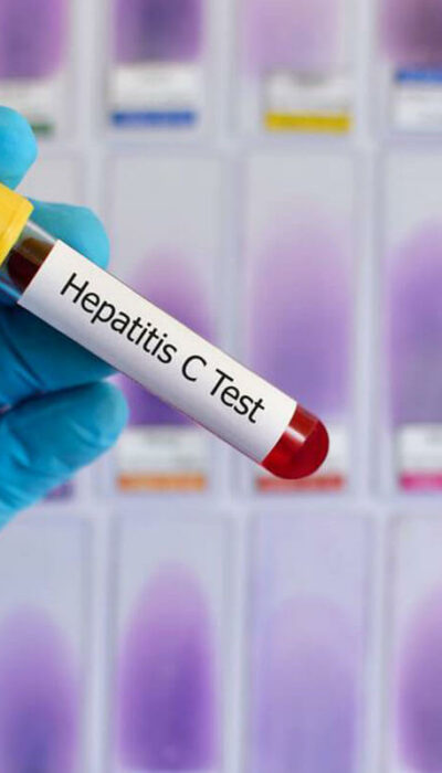 What to Expect from Hepatitis C Treatment