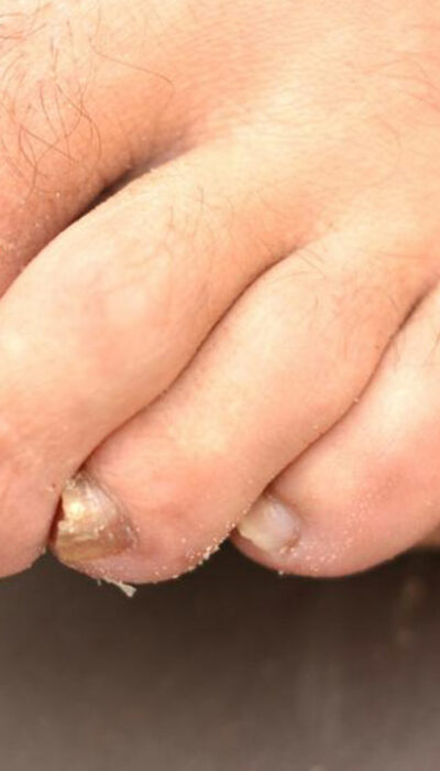 Toenail Fungus &#8211; Causes, Symptoms and Treatment