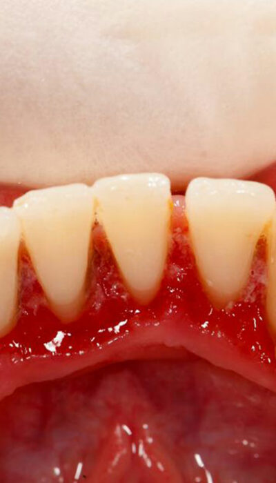 Top 8 natural treatments for gum disease