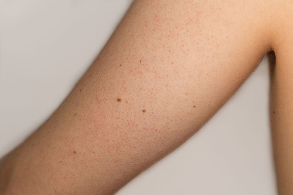 Top Treatment Options for Keratosis Pilaris