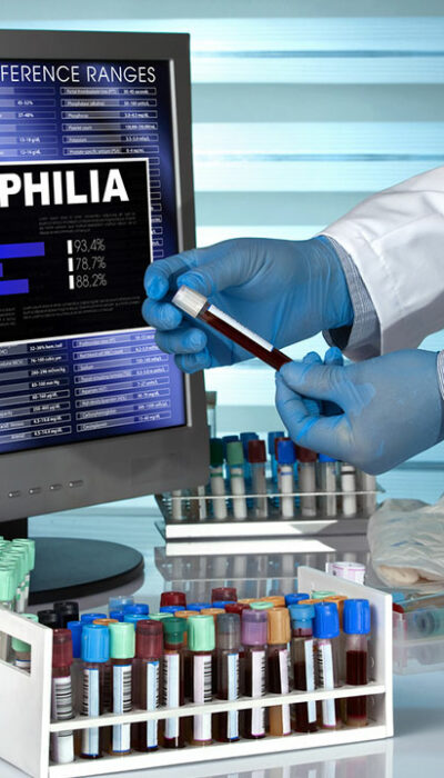 The Diagnosis and Prognosis of Hemophilia