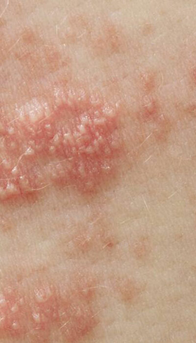 The Treatments for Shingles You Should Know