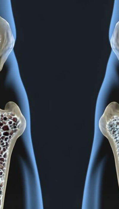 These Common Medical Conditions are Causing Your Osteoporosis Bone Loss