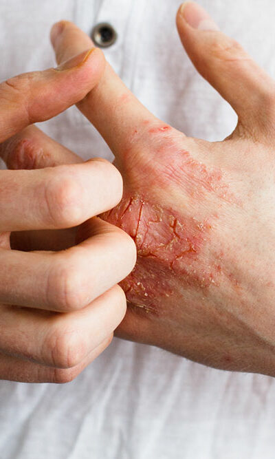 Things You Need to Know about Eczema