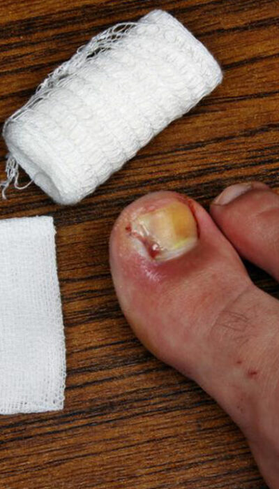 Tips to Cure and Prevent Toenail Fungus