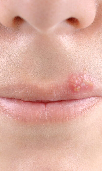 Tips to Treat Cold Sores Effectually