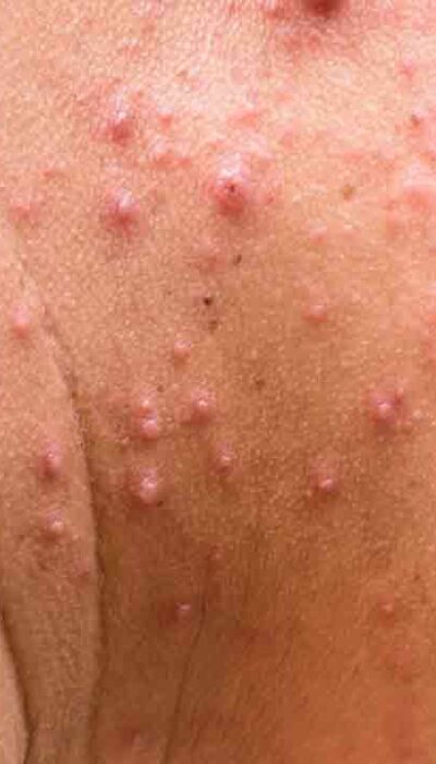 Tips to Treat Shingles Rash