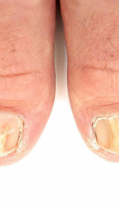 Try These 5 Ways to Effectively Treat Toenail Fungus