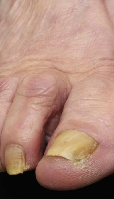 Try These Natural Methods to Cure Nail Fungus