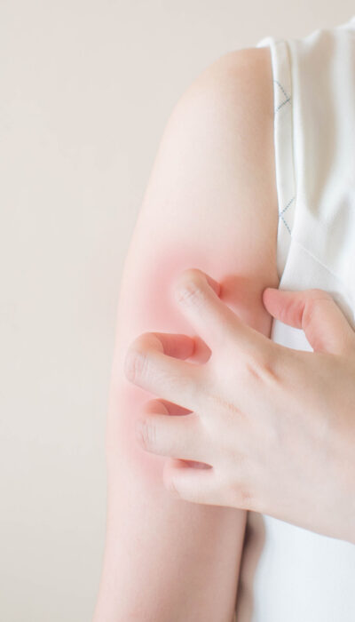 Treatment Options For Psoriasis