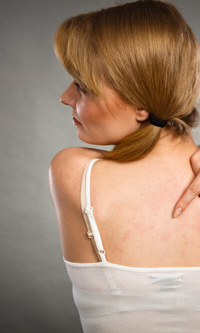 Treatment Procedures And Home Remedies For Eczema