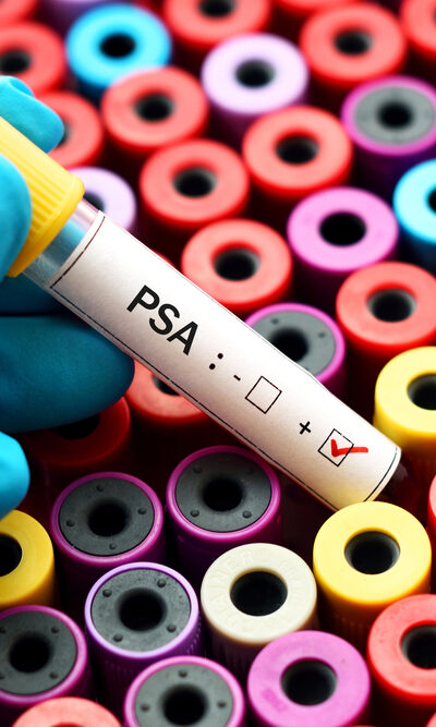 Understanding The Causes Of High Psa Levels