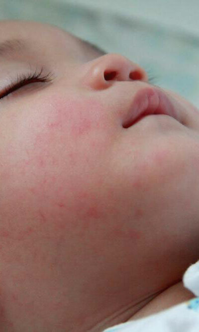 Understanding the Signs and Symptoms of Baby Eczema