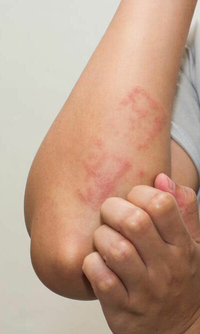 Various Effective Treatment Options For Atopic Dermatitis