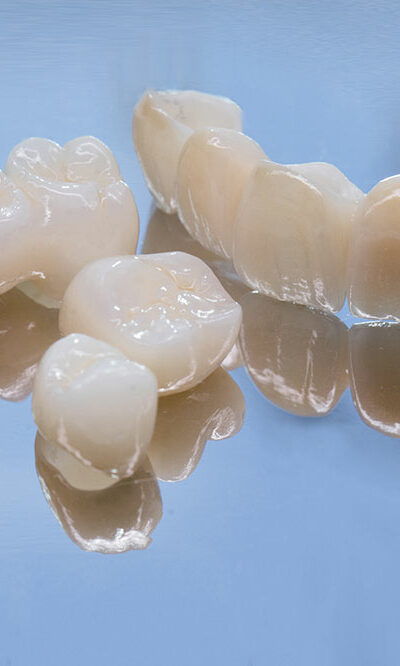 Things to Know Before Opting for Dental Bridges